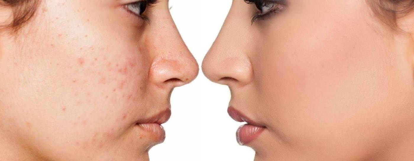 Targeted acne and blemish treatment