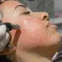 Stomach Tightening with Derma Pen